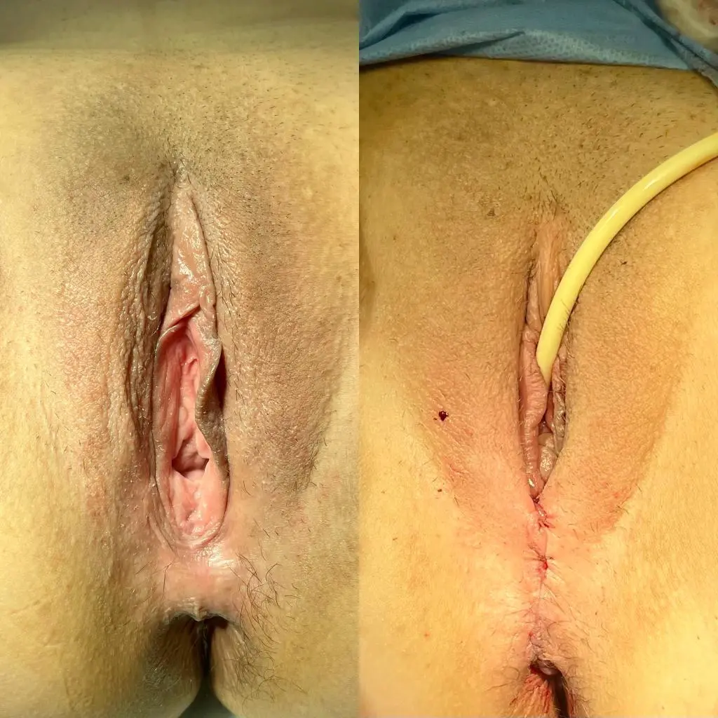 Vaginoplastia